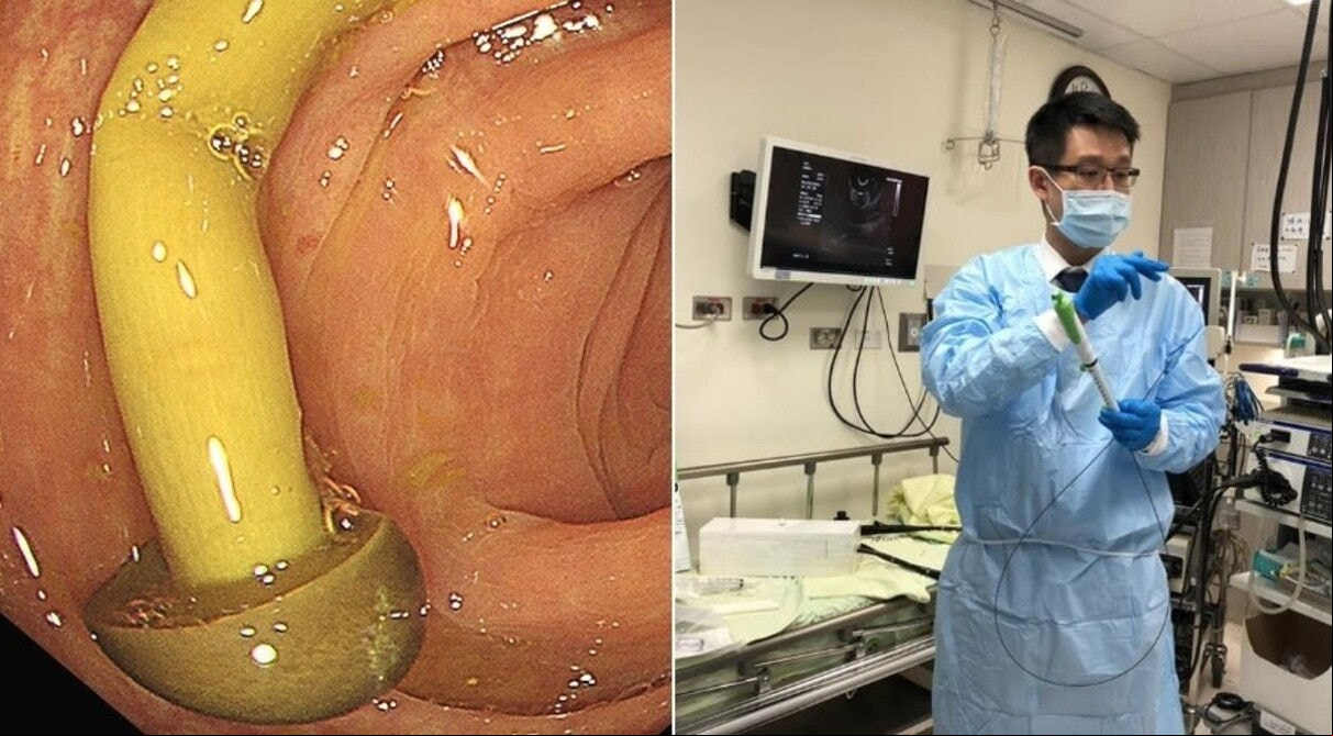 Médico descobriu cogumelo crescendo no intestino de paciente em Taiwan 
